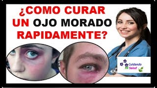 💡 COMO CURAR UN OJO MORADO  3 pasos para tratar y eliminar Moretones o Hematoma facial 2021 ✅ [upl. by Jasper]