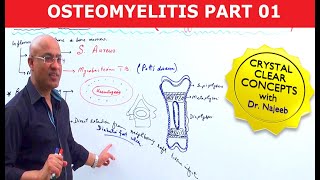 Acute Osteomyelitis  Orthopedics for Medical Students [upl. by Tlevesoor]