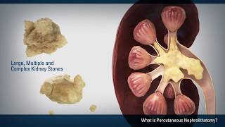 Percutaneous Nephrolithotomy PCNL [upl. by Perice]