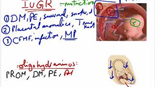 iugr  oligohydraminos [upl. by Hsak]
