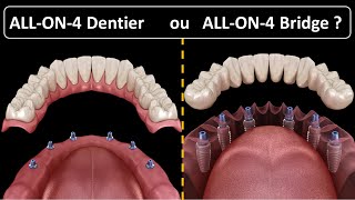 All on 4  Type de prothèse  Dentier ou Bridge [upl. by Nahtan88]