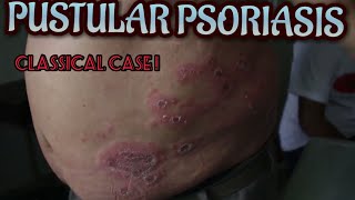 Dermatology  Pustular Psoriasis  Dr Suchana Marahatta  नेपालीमा [upl. by Reinnej]