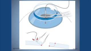 Astigmatism management after corneal transplantation  A State of Sight 44 [upl. by Alika]