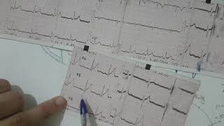 Bases dinterprétation dun ECG normal [upl. by Ranie707]