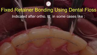 Bonding fixed permanent retainer in orthodontics with dental floss Asker Orthodontics twist flex [upl. by Dilisio]