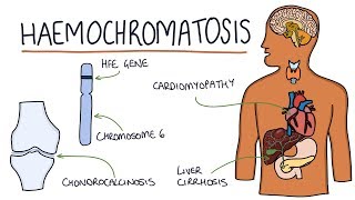 Understanding Haemochromatosis [upl. by Henrique828]