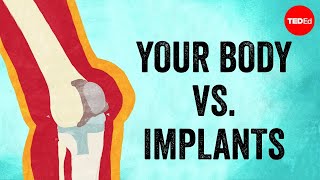 Your body vs implants  Kaitlyn Sadtler [upl. by Schmidt]