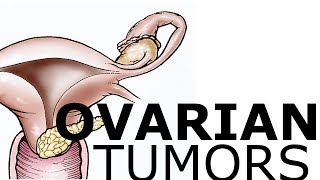 Ovarian Pathology amp Tumors [upl. by Peery]