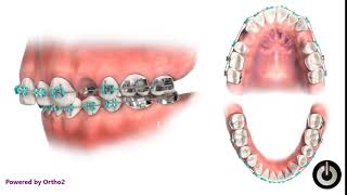 Upper First Premolar Extraction  Dental Braces  Temecula Valley CA [upl. by Emmit]