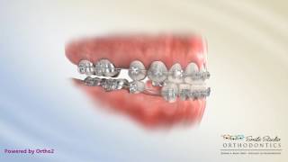 Upper 5 Lower 4 Extraction  Underbite  Orthodontic Treatment [upl. by Sethrida]