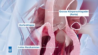 Das TAVIVerfahren  Behandlung einer Aortenklappenstenose [upl. by Eugenie]