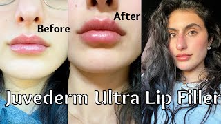 JUVEDERM ULTRA LIP FILLER 1 SYRINGE my experience  healing process [upl. by Maynord]