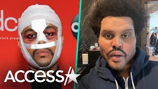 The Weeknd Finally Explains Face Bandages [upl. by Anirtac]