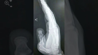 How do I Treat a Dislocated Thumb [upl. by Asenaj978]