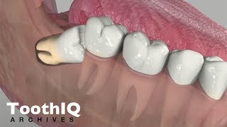 Impacted Tooth Removal [upl. by Lumpkin]