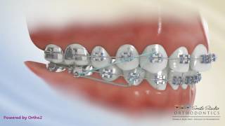 Elastics  Class II Triangle 3 to 46  Orthodontic Treatment [upl. by Eenobe]