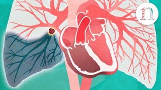 Pulmonary embolism The route to recovery [upl. by Idnal]