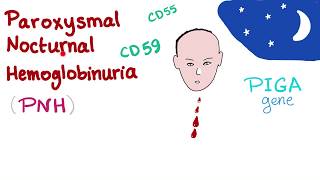 Paroxysmal Nocturnal Hemoglobinuria PNH  Hemolytic Anemia  Complement Alternative Pathway [upl. by Nosac]