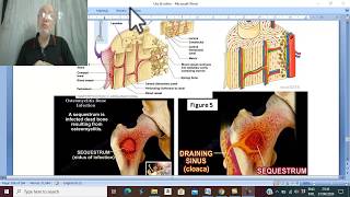 How to treat osteomyelitis [upl. by Gertrude842]