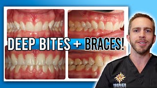 Deep Bite Braces Treatment BEFORE amp AFTER [upl. by Akemehc]