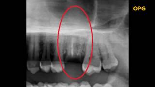 Extraction of Upper molar root stump Root canal treated [upl. by Meridel747]