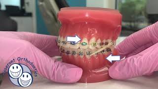 Elastics in Orthodontics  Overview [upl. by Nick]