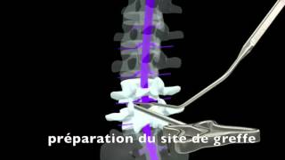 Arthrodèse par cage postérieure [upl. by Buck]