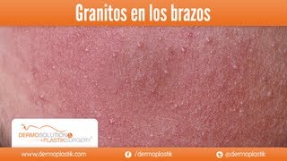 Dermoplastik  Granitos en los brazos [upl. by Ymrej]