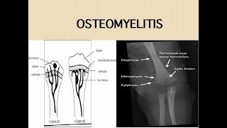 Acute Osteomyelitis [upl. by Ramedlav]