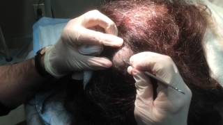 TOP CYST EXPLOSION I EXTRACTION VIDEO [upl. by Ocram561]