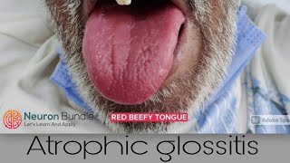 Atrophic glossitis BeefyRedTongue medschool clinicalexamination [upl. by Alfonzo]