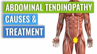 Abdominal Tendinopathy  Causes and Treatment Including Exercises [upl. by Elokcin745]