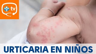 Urticaria en niños ¿cómo se produce ¿Tiene importancia [upl. by Othelia]