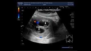 Early first trimester twin Pregnancy  08 weeks [upl. by Enyallij114]