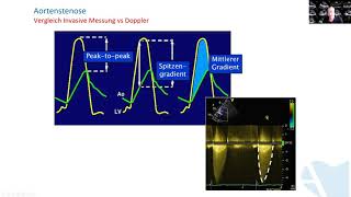 Quantifizierung der Aortenklappenstenose [upl. by Oiramel]
