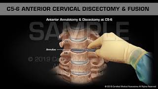 Life After ACDF Anterior Cervical Discectomy and Fusion [upl. by Atiuqihs]