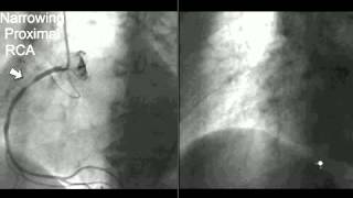 Coronary CT Angiography Cath [upl. by Eisdnil471]