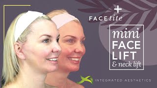 Mini facelift and neck lift using Inmode facetite device [upl. by Anesor]