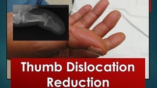 Thumb Dislocation Reduction [upl. by Eicyal]