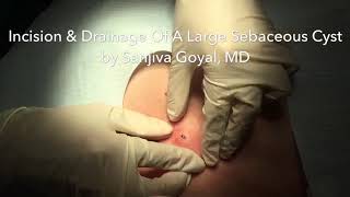 Incision amp Drainage of a Large Sebaceous Cyst [upl. by Virnelli981]