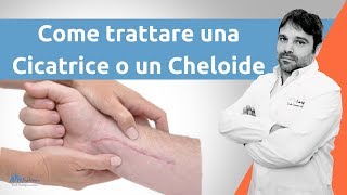 Come trattare una cicatrice cheloide [upl. by Marys]