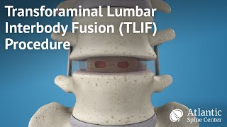 Transforaminal Lumbar Interbody Fusion TLIF Procedure [upl. by Drice]