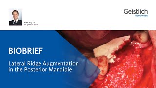 Lateral Ridge Augmentation in the posterior Mandible [upl. by Narej489]