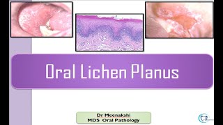 Oral Lichen Planus [upl. by Dalenna]