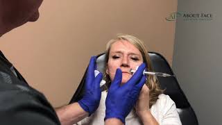 Juvederm Voluma Treatment Video [upl. by Roberto]