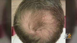 Can PRP Injections Spark Hair Growth [upl. by Sharyl]