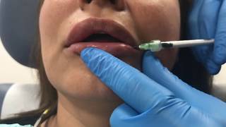 Reversing poorly placed lip filler using Hylenex hyaluronidase [upl. by Sirama403]