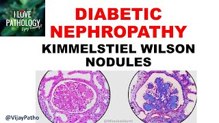 DIABETIC NEPHROPATHY Pathophysiology amp Morphology [upl. by Rosemonde]