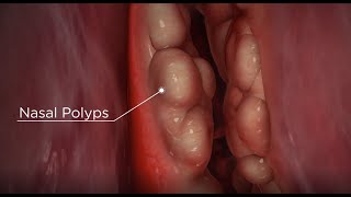 Nasal Polyps diagnosis and treatment options [upl. by Akenaj]