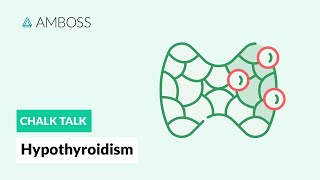 Hypothyroidism A Diagnostic Approach [upl. by Tenaej875]